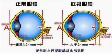 近視眼球突出？！控制近視度數(shù)加深是關(guān)鍵！