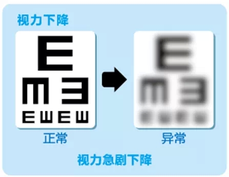 視網(wǎng)膜脫離啥癥狀？這張圖告訴你！