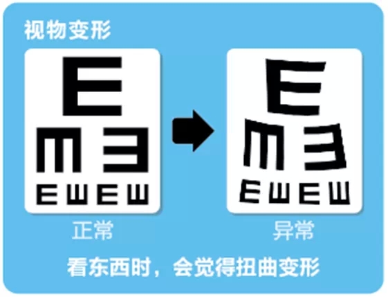 視網(wǎng)膜脫離啥癥狀？這張圖告訴你！