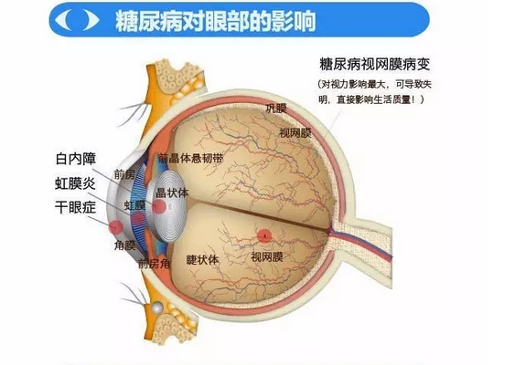 你造嗎？糖尿病晚期眼睛會(huì)致盲！