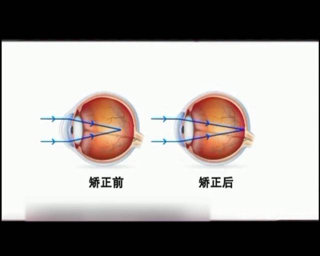 一夜之間真的能改變視力嗎？