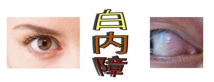 白內(nèi)障手術(shù)會反復(fù)嗎？