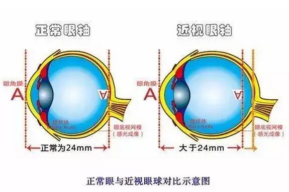 近視超過(guò)600度以上？這7條“錦囊”請(qǐng)收好！