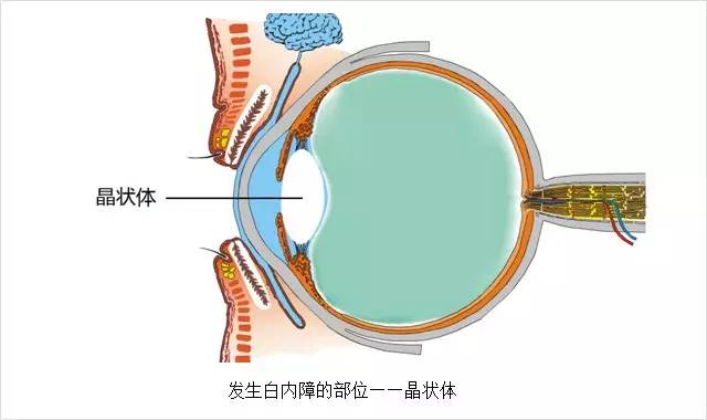 眼科主任告誡白內(nèi)障這幾大誤區(qū)，80%的老人上當(dāng)