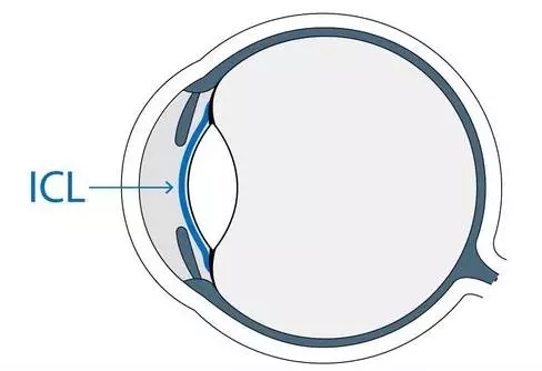 想做ICL晶體植入術(shù)，你需要了解的全在這里!